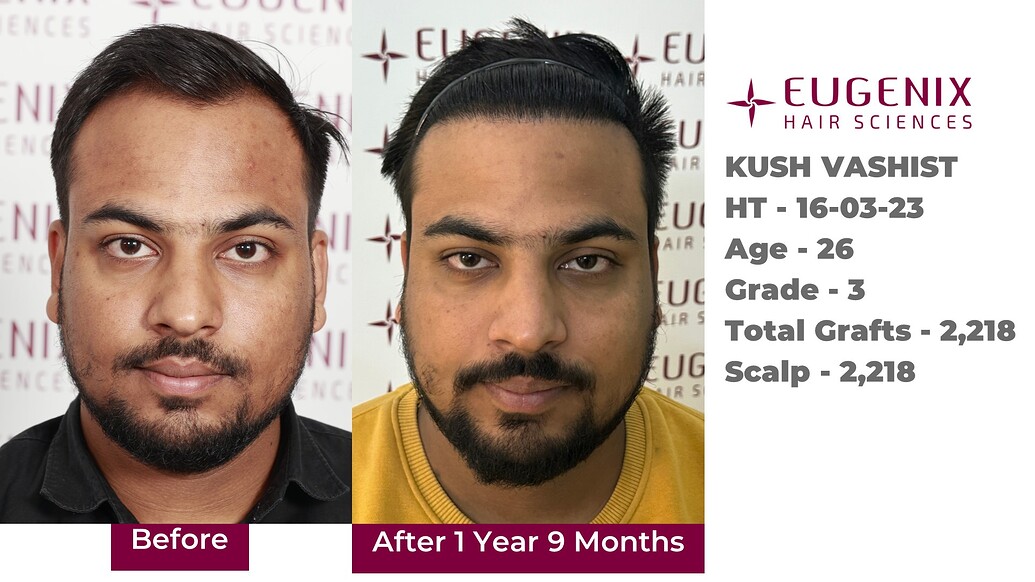 https://cdn.forumhairtransplant.com/optimized/3X/e/b/eba70eedf73530be9509a46bdf816521c5dd6246_2_1035x582.jpeg