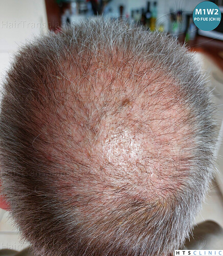 Dr Devroye + Dr Montesanti + Dr Jenard / 7015 grafts (4512 FUT + 2503 FUE) / 2 sessions photo