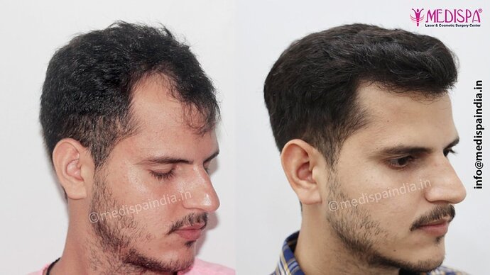 Dr. Suneet Soni - 2500 FUE Grafts, NW- III photo