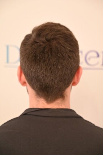Ozlem Bicer MD-2340 Grafts FUE by micro-motor, 12. month result  photo