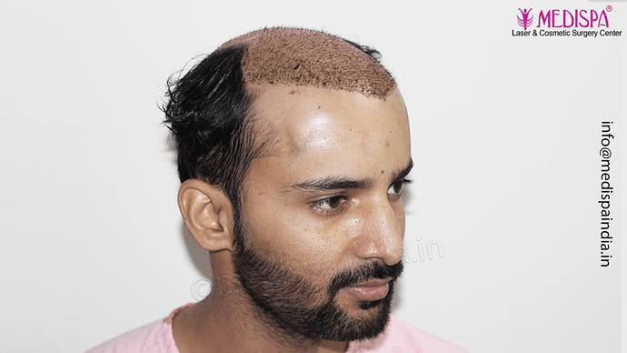 Dr. Suneet Soni - 4046 Grafts | 12-Month Result | Combination FUT + FUE + Beard photo