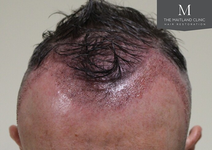 3487 grafts by FUE over 2 procedures photo