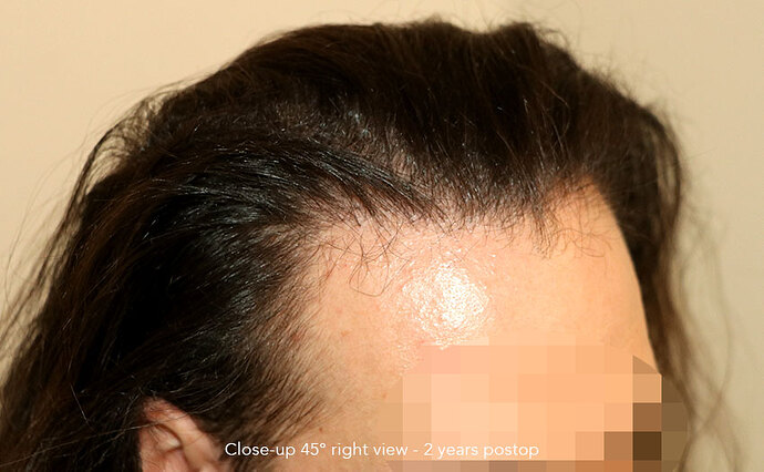 Case performed by Dr. Feriduni – 3346 FU in 1 procedure photo