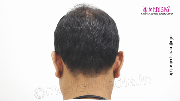 Dr. Suneet Soni - 4533 Grafts, Combine FUT + FUE Technique , NW-IV/V photo