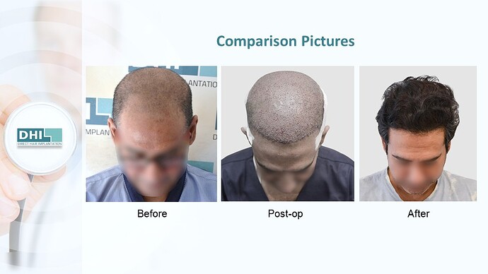 DHI India™ | NW 4 | 3,759 Grafts | 1 year DHI Hair Transplant Results photo