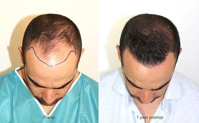 Case performed by Dr. Feriduni – 3505 FU in 1 procedure photo