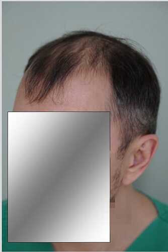 Hattingen Hair Clinic, 4 435: 4 093 FUT and 342 FUE. photo