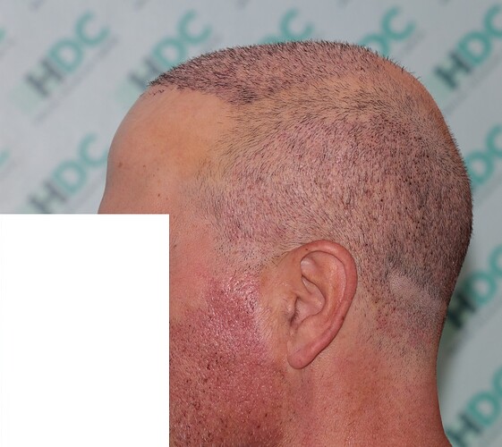 Major Repair of Mini Grafts - Result: 4160 Grafts – HDC Hair Clinic photo