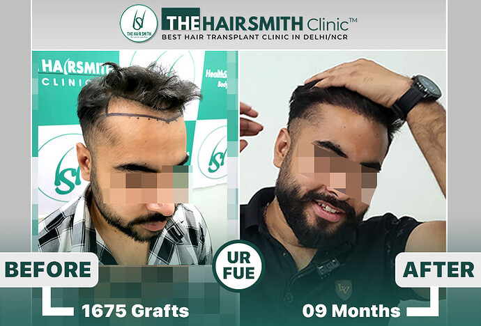 The HairSmith Clinic™ | NW Stage 3 | 1675 Grafts | 9 Months Hair Transplant Result photo