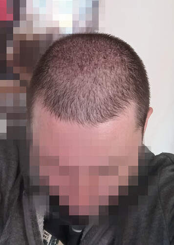 Dr Fares Seffen (Tunis, Tunisia) 2766 FUE results (Midscalps + Vertex) Day 0 --> 07 Months later photo