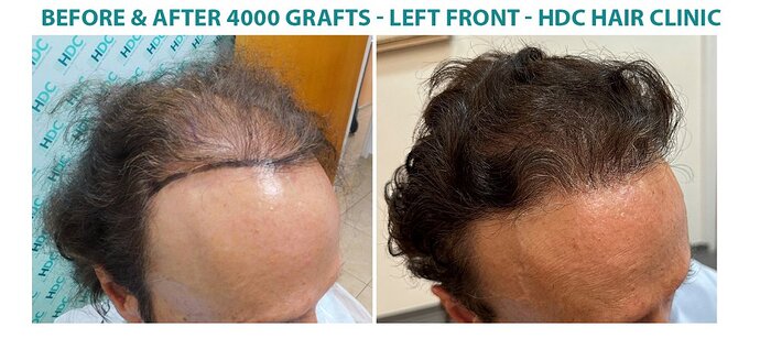 Hair Transplant Outcome with 4000 Grafts Across NW5 Zone – HDC Hair Clinic photo