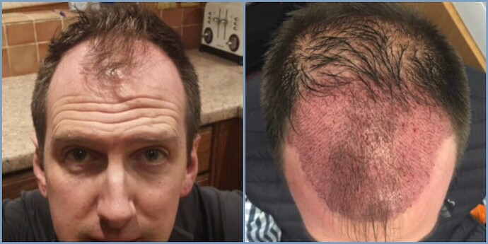 Dr. Nikos - 2450 grafts hairline to mid-scalp rebuild photo