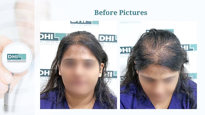 Female Hair Transplant | 1,359 Grafts | 6-Months Result | DHI India™ photo