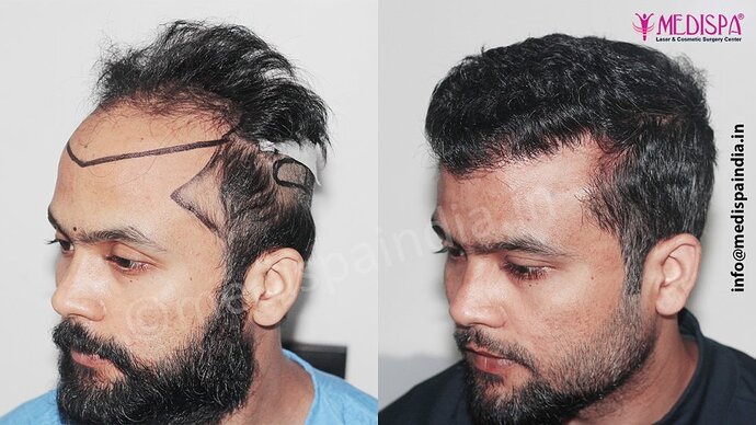 Dr. Suneet Soni - 5320 Grafts, Combine FUT + FUE Technique , NW- IV photo