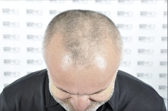 Asmed Clinic - FUE Hair Transplant - 5041 Grafts photo