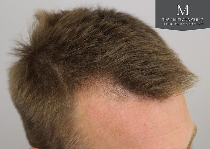 Dr Ball - The Maitland Clinic 1204 Grafts By FUE photo