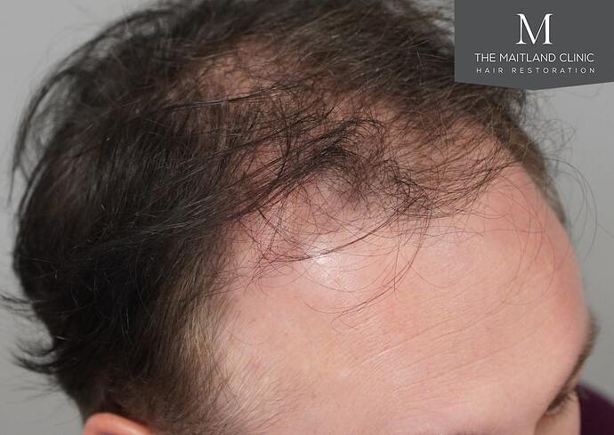 Dr Ball - The Maitland Clinic 2032 Grafts By FUE photo