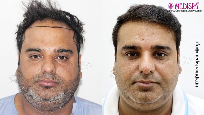 Dr. Suneet Soni - 4500 Grafts, 3 Year Result, NW-IV, Combine FUT + FUE Technique photo