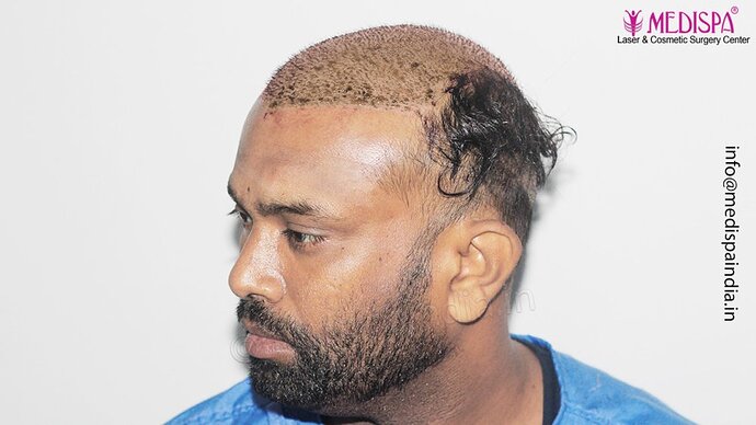 Dr. Suneet Soni - 5498 Grafts, 2 Years Result, Combine FUT + FUE + Beard Technique, NW-VI photo
