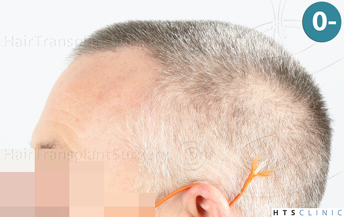 Dr. Jean Devroye, HTS Clinic / 2052 FUE / Hairline restoration photo