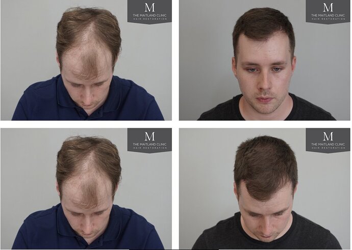 The Maitland Clinic - 2027 grafts by FUE photo