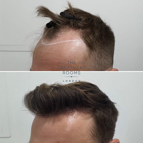 Receding hairline result- 1724 grafts FUE Hair Transplant photo