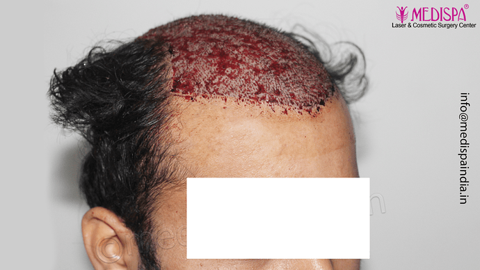 Dr. Suneet Soni - 5467 Grafts, Combine FUT + FUE + Beard Technique, NW- V, 3 Years Result photo