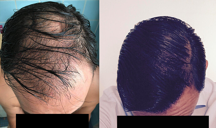 DR HAKAN DOGANAY/4055 GRAFTS/FUE+Implanter Pen photo