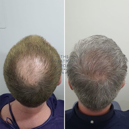 2322 Grafts Hairline and Crown FUE Hair Transplant photo