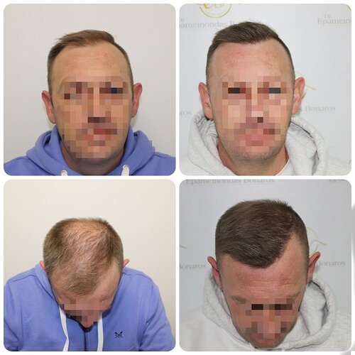 Dr Bonaros, Glasgow, UK / Receding Hairline Hair Transplant Result / 1814 FUE grafts / 0-12 Months photo