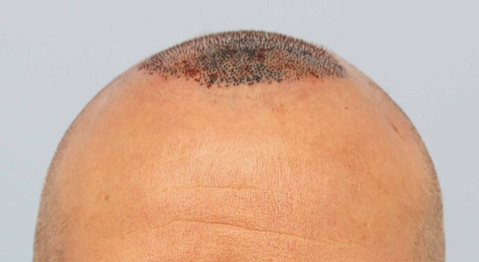 Dr B Farjo 1700g FUE (Front) photo