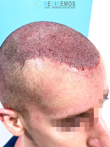 Dr Lupanzula E. | Medikemos Clinic: 3,951 Grafts, FUE, Front / Mid-scalp photo