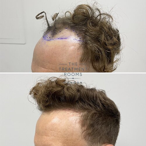 1514 Grafts Hairline Hair Transplant- The Treatment Rooms London photo