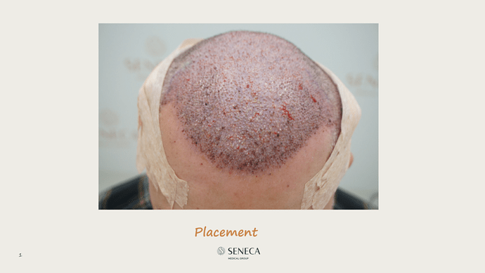 Seneca Medical Group - 3000 grafts with Direct Fue photo