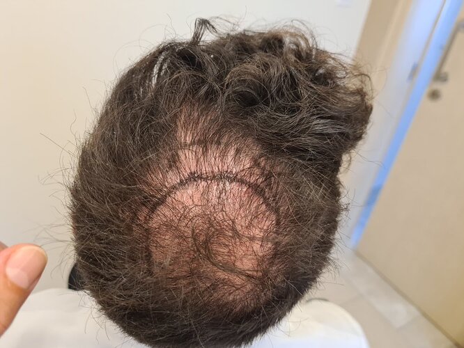 Crown Result of 3rd FUE for 2410 Grafts – HDC Hair Clinic photo