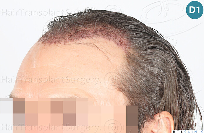 Dr Devroye + Dr Montesanti + Dr Jenard / 2005 FUE Partial shave / Hairline & temple corners photo