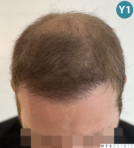 Dr. Jean Devroye, HTS Clinic / 3054 FUE / Hairline & front-mid restoration photo