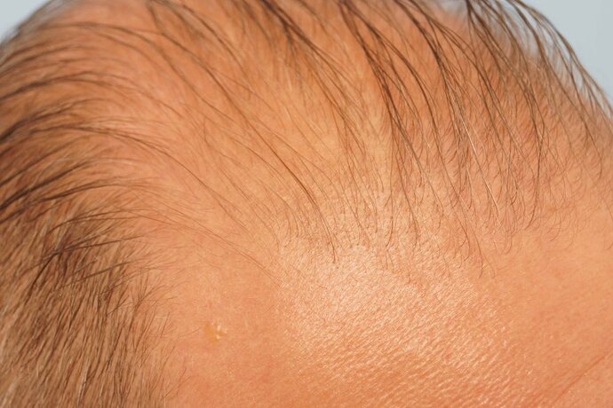 Dr B Farjo 1700g FUE (Front) photo