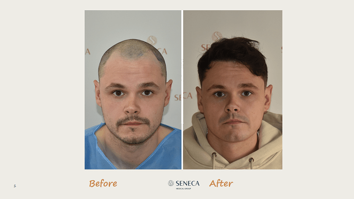 Seneca Medical Group - 1346 grafts with Direct Fue photo