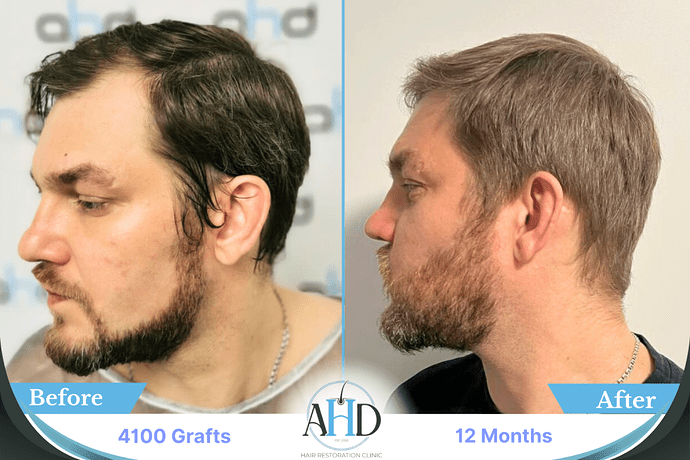 AHD Clinic Turkey - Hair Transplant Before & After Pictures - 4100 grafts - DHI photo