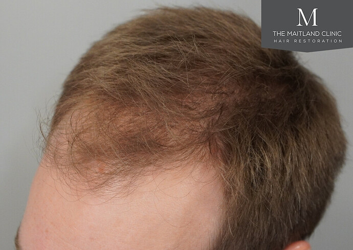 1826 grafts by FUE with Dr Edward Maitland Ball at The Maitland Clinic photo