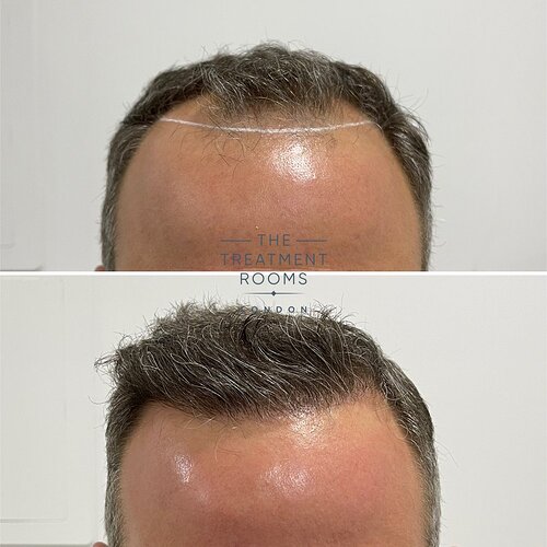 The Treatment Rooms London- 1788 Grafts Hairline Transplant Result photo