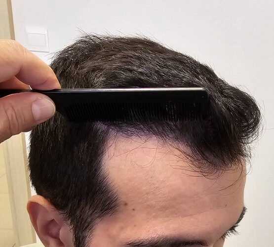 FUE Hair Transplant Result for 3100 Grafts - NW3 – 8 Months After – HDC Hair Clinic photo