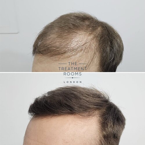 Hair Transplant Repair- 1733 Grafts photo