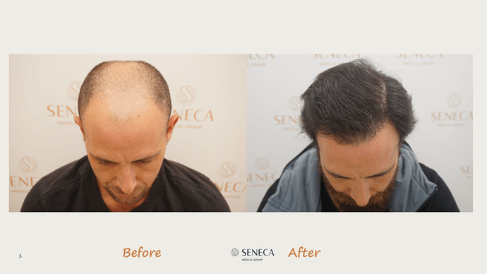 Seneca Medical Group - 3612 grafts with Direct Fue photo