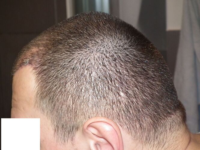 Dr.Bisanga, BHR Clinic, 2519 FUE 0 - 6 Months photo