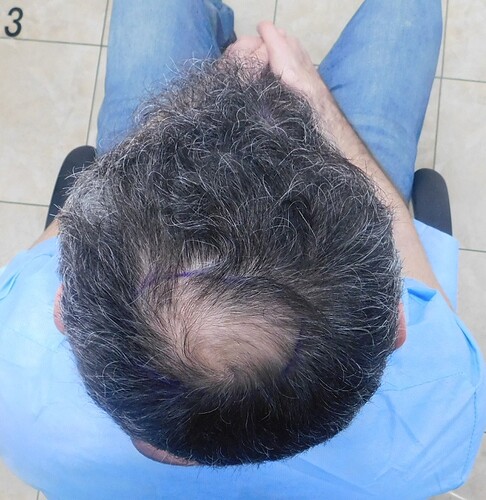 Result of Class 3V Patient – 3530 Grafts – HDC Hair clinic – Dr Maras photo