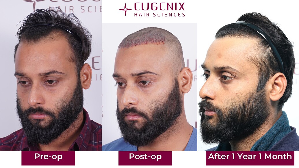 https://cdn.forumhairtransplant.com/optimized/3X/f/1/f14f3367d22deacb95195c85f63d1328190c1809_2_1035x582.jpeg