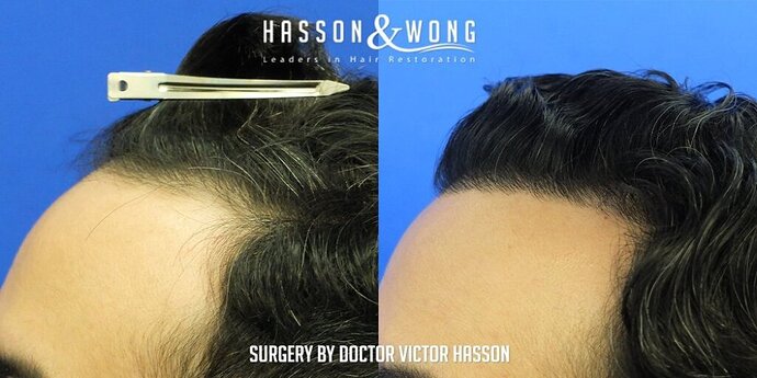 Dr. Hasson / 2,500 grafts / FUE / Hairline / 1 Year Post-op photo