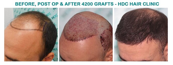 Two FUE Surgeries Totaling 6560 Grafts – HDC Hair Clinic photo